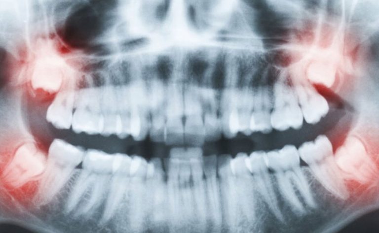 Quanto Costa Estrazione Dente Del Giudizio