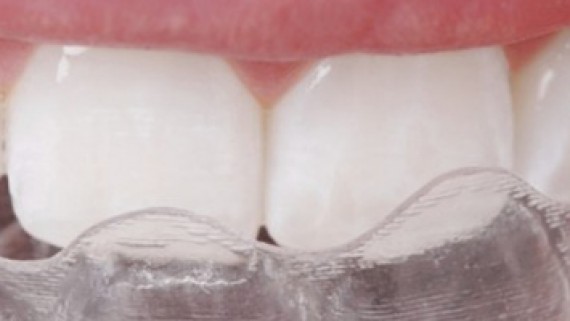allineatore trasparente per raddrizzare i denti
